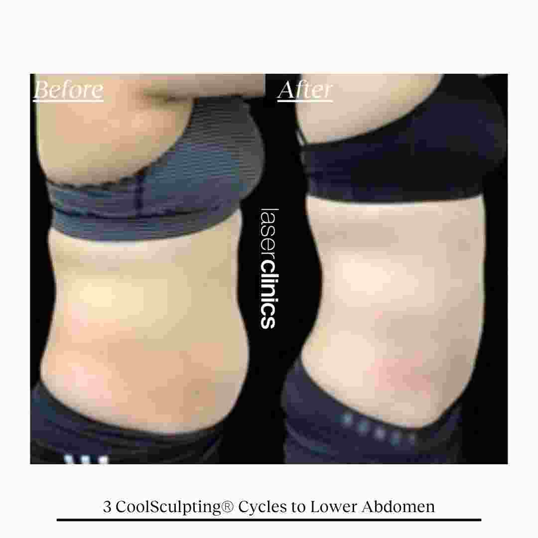 COOLSCULPTING  (10).jpg